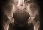 Pelvic X-Ray